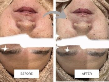 リンネ(Rin'ne)/【1回の効果】プレミアムコース