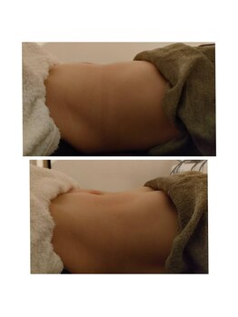 トータルエステティック ジョワイユ(JOYEUX)/お腹脂肪集中ケア