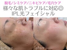 オリエンタルローザ 表参道(Oriental Rosa)/ハリ艶肌へ◎IPL光フェイシャル