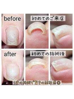 ミミカケルソラ(mimi×sora)/巻き爪補正☆