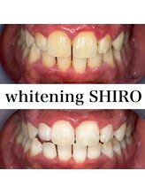 福岡ホワイトニングシロ 天神中洲店(福岡ホワイトニングSHIRO)/【ホワイトニング】before/after
