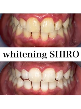 福岡ホワイトニングシロ 天神中洲店(福岡ホワイトニングSHIRO)/【ホワイトニング】before/after
