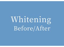 ホワイトニングカフェ 金沢店(WhiteningCafe)/◎歯のホワイトニング施術写真◎