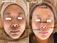 リノアンド(Lino&)/剥離なし天然ハーブピーリング