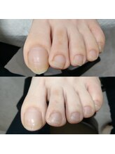 ドクターネイル爪革命 長野店/【美爪ケア】ネイル/フット