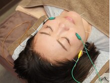 和み治療院 南浦和店/【学割U24】で美容鍼