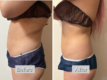 オレンジ(Orange)/2部位/痩身マシンBefore After