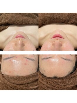 ナチュレ(Nature)/ニキビを気にした生活に終止符！