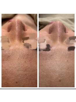 リグレム バイ フェローズ(Riglem by fellows)/hydroトリートメント×CARBOXY