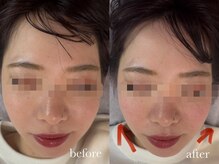 エネ ラッシュアンドブロウ バイ アンドエラ(ENNE Lash&Blow by&ERA)/小顔整体