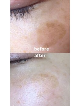 セレネ(SELENE)/100円玉サイズのしみ