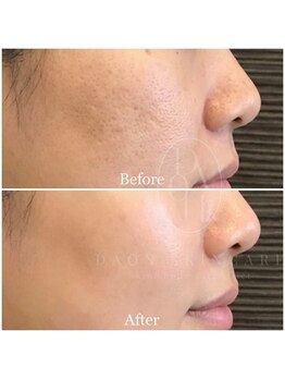 多穏スキンケア(skin care)/人気No.2サーマルフラクショナル