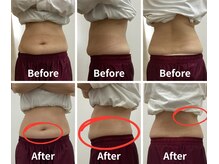 Noa接骨院 はりきゅう院/脂肪冷却　B/A写真