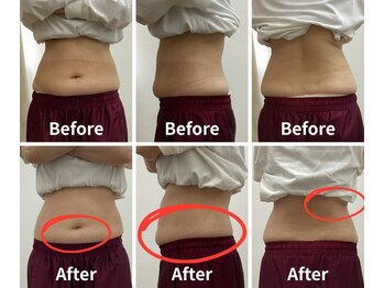 Noa接骨院 はりきゅう院/脂肪冷却 B/A写真