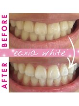 エクシアホワイトニング 西尾店/ビフォーアフター