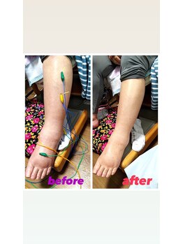 きらめき鍼灸治療院/足のむくみ改善♪