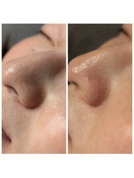 トリニティスペース(TrinitySpace)/オプション鼻ハーブピーリング