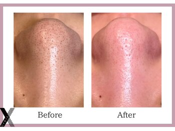 クロス(Xcross)/毛穴ケア【毛穴/代官山/渋谷】