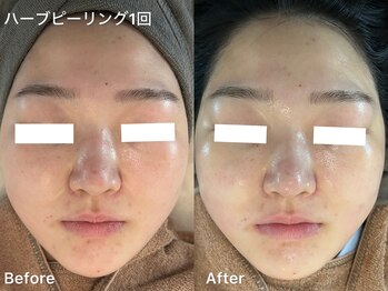 プティ 横浜店(Petit)/ニキビケア/ハーブピーリング