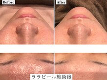 フレイヤ(FREYA)/ララピールBefore→After