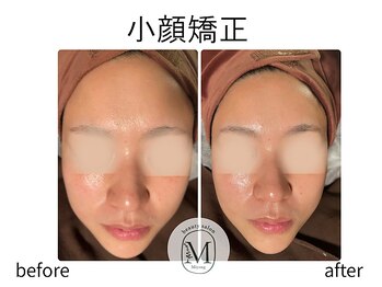 ミヨン(Miyong)/小顔矯正　