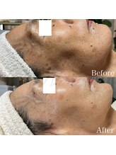 ニュアージュ(Nuage)/70代女性/肌全体の若々しさ