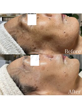 ニュアージュ(Nuage)/70代女性/肌全体の若々しさ