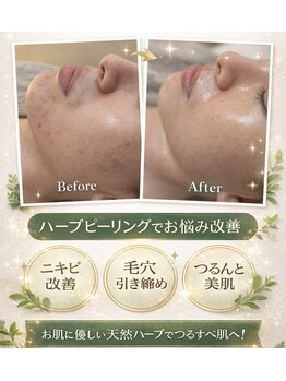 エレナ(Elena)の写真/ニキビケア専門☆何をしても改善されなかったお悩みお任せください。荒れないお肌を育てます☆