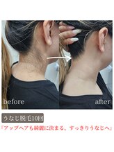 ティンクル サロン(Twinkle salon)/うなじ脱毛で後ろ姿美人