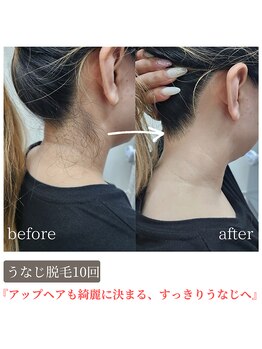 ティンクル サロン(Twinkle salon)/うなじ脱毛で後ろ姿美人