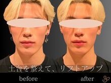 チョコバリ 恵比寿店(chocobari)/小顔リフトアップ（美容鍼）20代