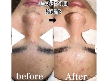 ベルフルール 浜松中野町店/毛穴エクストラクション