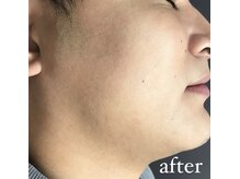 リリーブー 池袋(Lilyboo)/ヒゲ脱毛