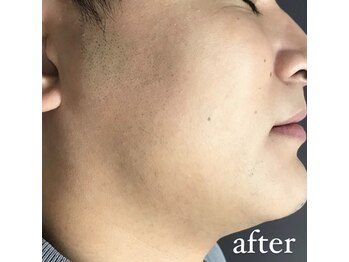 リリーブー 池袋(Lilyboo)/ヒゲ脱毛