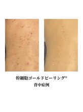 リメイクビューティークリニック(REMAKE BEAUTY CLINIC)/Body幹細胞ゴールドピーリング