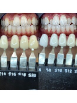 トウキョウスワーズ 池袋店(TOKYO SWRS)/#ホワイトニング #池袋 #渋谷