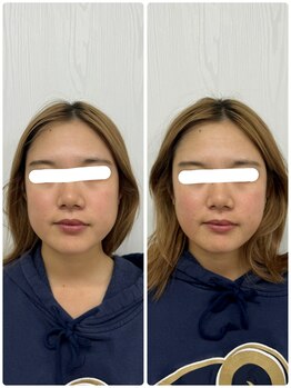 ラフテル鍼灸整骨院/土日祝営業の小顔矯正♪