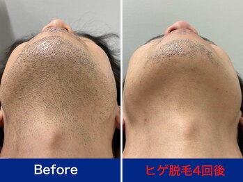 ミスターアンクール 鹿児島(Mr.uncoeur)/ヒゲ脱毛4回後