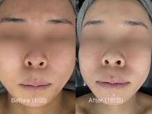 ウルト アルティメイトスキン(ULT ultimate skin)/根本的にお肌改善！