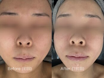 ウルト アルティメイトスキン(ULT ultimate skin)/根本的にお肌改善!