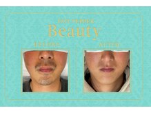 サロンエス 高田神楽店(SALON S)/当サロンのヒゲ症例写真です♪