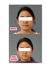 根津整骨院/メディチャーライトの小顔矯正