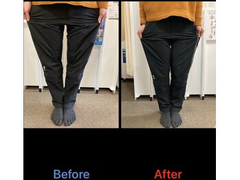 ごうだ整骨院/О脚矯正