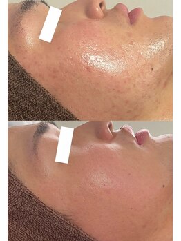 エミルカ 神戸三宮(EMILUCA)/肌荒れ