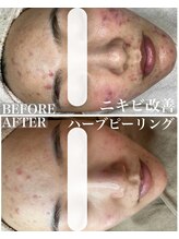 リラックスアンドビューティー ラマナ(la mana)/毛穴ケア+ハーブピーリング &nbsp;3回
