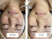 リンネ(Rin'ne)/ハイドラ毛穴×ハーブピーリング