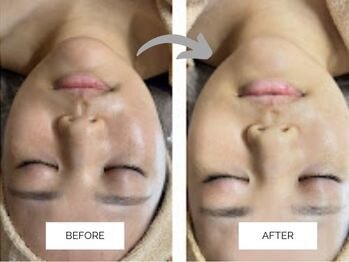 リンネ(Rin'ne)/毛穴洗浄×ハーブピーリング