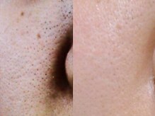 フルリール/【超音波毛穴洗浄＆全顔脱毛】