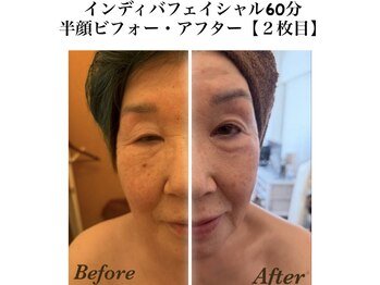 プレジール エテ(plaisir Ete)/インディバ顔60分施術前後