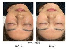 サロン ピューパ(Salon pupa)/ハーブピーリングBefore→After